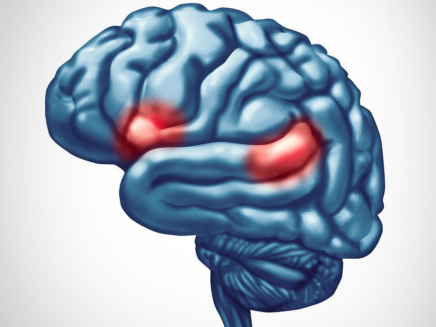 areas of brain affected by aphasia in a stroke victim