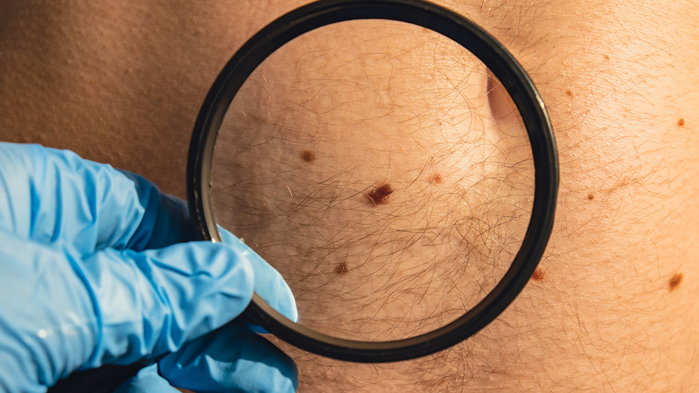 doctor using magnifying glass on a mole during skin cancer screening